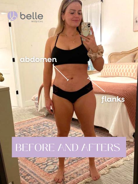 See before and afters! Fat Transfer, Stretch Mark Removal, Makeover Before And After, Stretch Mark Cream, Iv Therapy, Mommy Makeover, Hormone Replacement, Stomach Fat, Fat Removal