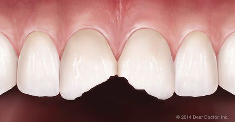 The most common type of dental injury is a chipped tooth. Fortunately, chips in teeth are usually quite easy to repair with dental bonding, veneers or crowns. #chipped #tooth Chipped Teeth Repair, How To Fix A Chipped Tooth, Chipped Tooth Repair, Fix Teeth, Tooth Crown, Chipped Tooth, Dental Bonding, Dental Insurance Plans, Tooth Repair