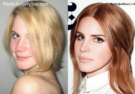 Lana Del Rey, before she was famous? Lana Del Rey Lips, Lip Goals, Surgery Nose, Nose Surgery, Facial Plastic Surgery, Injectables Fillers, Celebrity Plastic Surgery, Celebrities Before And After, Under The Knife