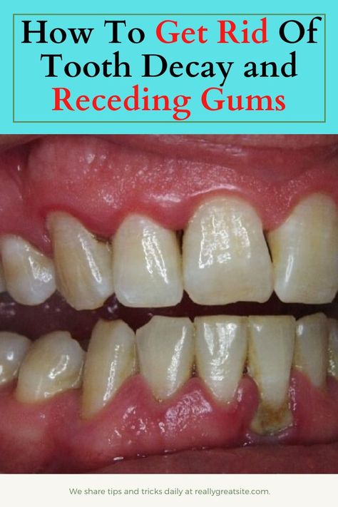 Reverse Receding Gums, Tooth Decay Remedies, Perfect Teeth, The Teeth, Oral Care Routine, Receding Gums, Gum Care, Gum Health, Teeth Care