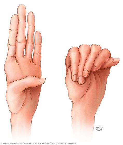 Long Fingers, Duchenne Muscular Dystrophy, Brain Surgeon, Genetic Disorders, Ehlers Danlos Syndrome, Heart Problems, The Skeleton, Nursing Notes, Chest Pain