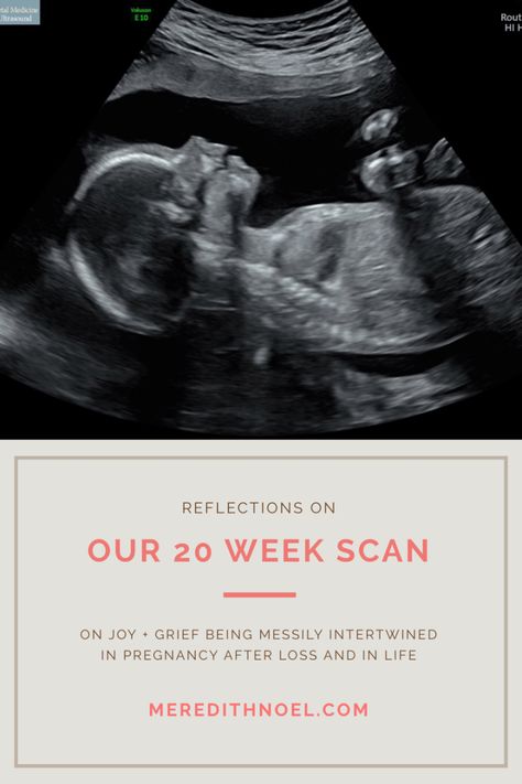 Pregnancy Scan, Med Doctor, 20 Week Scan, 21 Weeks Pregnant, Pregnancy After Loss, 20 Weeks Pregnant, Kids At Home, Overcome The World, Child Loss