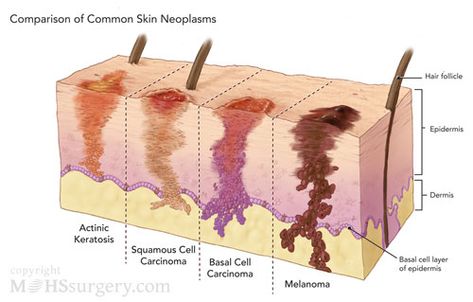 Lesions Skin, Skin Anatomy, Skin Picking, Integumentary System, Squamous Cell, Skin Structure, Skin Disorders, Types Of Cancers, Anatomy And Physiology