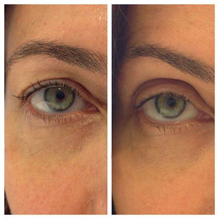 Even if you find the promise of youthful, taut, post-eye-lift skin tempting, there's a fair chance that you're put off by the cost, risk, and needles required to look like it's still 1999. Enter... Fibroblast Before And After Eyes, Eye Lid Surgery Before And After, Eye Lid Lift Droopy Eyelids, Natural Eye Lift, Fix Droopy Eyelids, Eye Brow Lift, Lift Eyelids, Botox Eyebrow Lift, Eye Lift Surgery