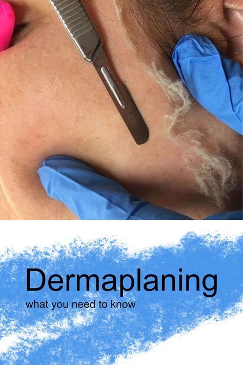 Dermaplaning - Everything You Need To Know Dermaplaning Vs Waxing, How Often To Dermaplane, Dermaplaning Aesthetic, Peach Fuzz On Face, Derma Planning, Medical Esthetics, Dermaplane Facial, Dermaplaning Facial, Popular Everything