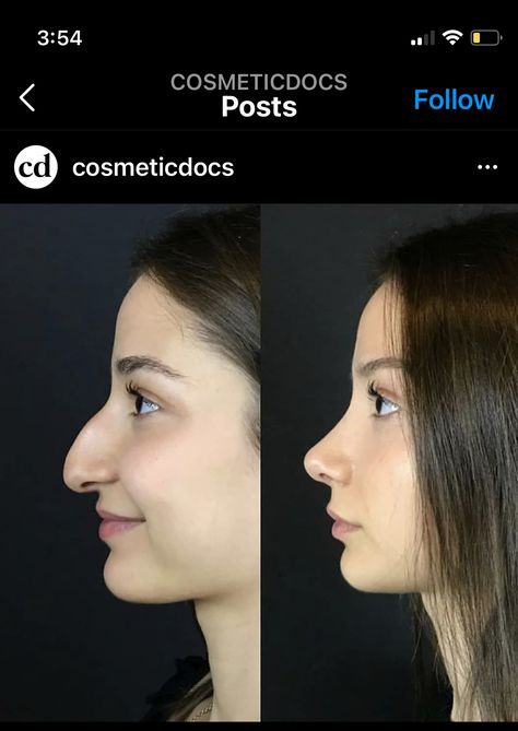 Nose Job Droopy Tip, Fake Nose Job Makeup, Nose Jobs Before And After, Perfect Nose Rhinoplasty, Aqualine Nose, Round Tip Nose, Nose Job Before And After, Nose Job Inspiration, Nose Job Inspo