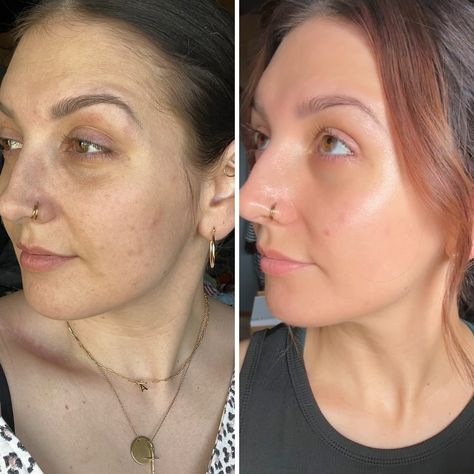 I. Am. Blown. Away. ➕ first click that F0LL0W ☑️ secondly SAVE this for later so you don’t lose this info! 6 months with Korean skincare has completely transformed my skin! 😳 Both same time of day & window (just different seasons aka winter vs summer so the sunlight is a little brighter in the afters) ✔️ Smoother skin. ✔️ Glowy, even & hydrated. ✔️ Reduced redness. ✔️ Brighter & tighter eyes. ✔️ Minimized pores. ✔️ Sun spots disappearing. ✔️ Elasticity improved. ✔️ Less breakouts & fast... Korean Skincare Routine, Minimize Pores, Smoother Skin, Puffy Eyes, Dull Skin, Korean Skincare, My Skin, Busy Mom, Beauty Nails