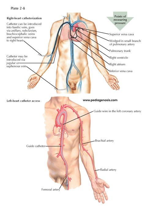 Right Heart Catheterization, Cardiology Study, Cath Lab Nursing, Ablation Surgery, Cardiac Cath, Patent Ductus Arteriosus, Nursing Tools, Heart Catheterization, Atrial Septal Defect