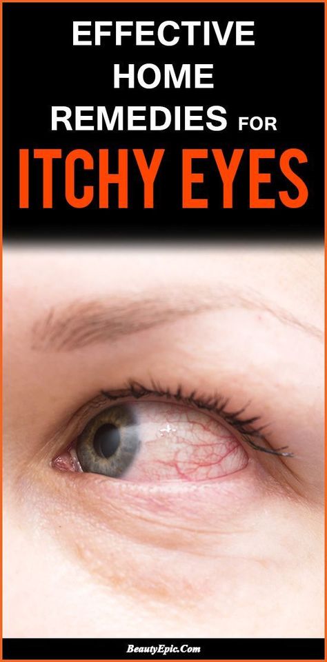 7 Quick Home Remedies For Itchy Eyes That Start Working Right Now Remedies For Itchy Eyes, Remedies For Dry Mouth, Home Remedies For Allergies, Home Remedies For Warts, What Causes High Cholesterol, Warts Remedy, Natural Remedies For Migraines, Sunburn Relief, Dry Skin Remedies