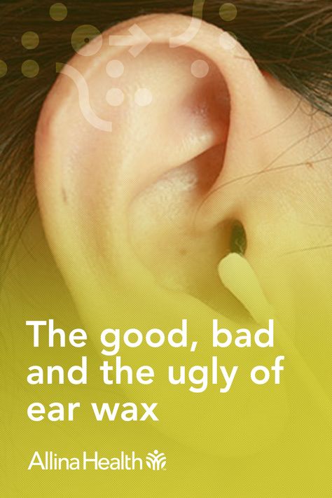 You may have heard the saying, "you should not put anything in your ears that is smaller than your elbows." But how many of us actually listen to that? If you have plugged ears or ear wax buildup, our blog article will teach you why you shouldn't reach for a Q-tip, ear wax removal candle, or other ear wax removal tools. Learn more about safe ear wax removal and plugged ear remedies. Plugged Ears, Plugged Ears Remedy, Ear Wax Removal Diy, How To Clean Ear Wax Out, Sweet Oil For Ears, How To Clean Ear Wax Out At Home, How To Unplug Ears, Remove Ear Wax Buildup At Home, Cleaning Ears Wax How To Remove