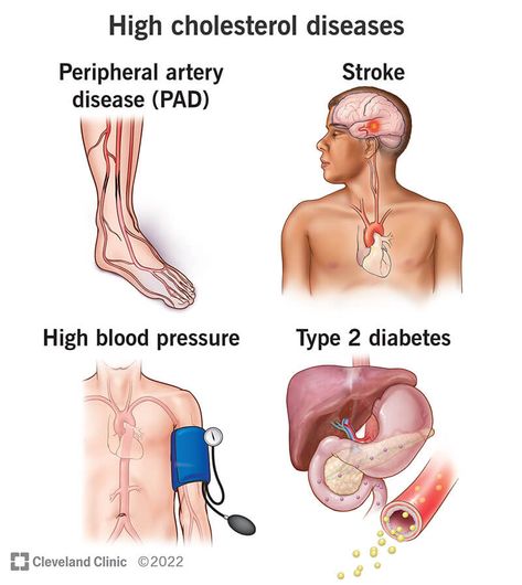 What Is Cholesterol, Lower Ldl Cholesterol, Personalized Medicine, Cleveland Clinic, Ldl Cholesterol, Reduce Cholesterol, High Cholesterol, Cholesterol Levels, Cardiovascular Disease