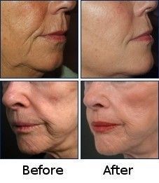 Did you know that facial yoga toning exercises can firm and tauten saggy cheeks and jowls within days? Women and men just love their new natural facelifts Saggy Cheeks, Saggy Jowls, Face Lift Exercises, Sagging Cheeks, Toning Exercises, Natural Face Lift, Facial Toning, Facial Yoga, Face Exercises