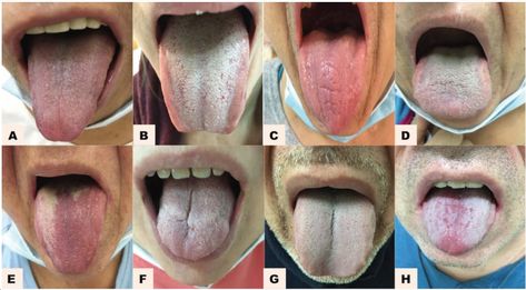 Breakthrough AI detects diseases with 98% accuracy via tongue scans - The Brighter Side of News Tongue Color Meaning, Human Tongue, University Of South Australia, Zinc Supplements, Color Meanings, Medical News, Traditional Chinese Medicine, Spot On, Disease