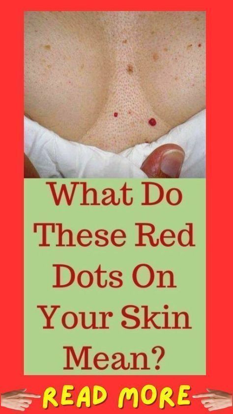 Red Skin Spots, Best Cough Remedy, What Is Health, Healthy Living Inspiration, Health Signs, Women Health Care, Health Tips For Women, Lose 40 Pounds, Healthy Lifestyle Tips