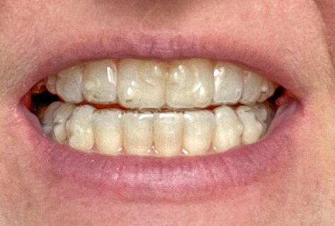 I just finished up 28 weeks of Invisalign. I’ve gotten so many questions about the process so I thought I would answer the FAQs here. Plus, I am sharing 14 weeks Invisalign results photos and 28 week Invisalign results photos! After years of putting it off, I am finally getting my teeth fixed. Again. I […] The post My Invisalign Experience | 14 Week Invisalign Results 28 Week Invisalign Results appeared first on thekittchen. Teeth Invisalign, Invisalign Before And After, Invisalign Aesthetic, Invisalign Hacks, Invisalign Tips And Tricks, Before And After Invisalign, Invisalign Marketing, Invisalign Progress, Braces Or Invisalign