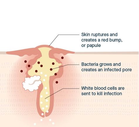 We say it all the time, but it’s technically not true: pimples don’t just “pop up.” By the time we notice a spot in the mirror — or feel a nodule coming on — that blemish has been brewing for a bit. Every pimple goes through phases: but why are those stages important? Because when you’re trying to treat acne, understanding what’s happening to your skin is the first step toward a clearer complexion. Sandra Lee, Treat Acne, White Blood Cells, Clear Complexion, Blood Cells, But Why, How To Treat Acne, Life Cycle, Life Cycles