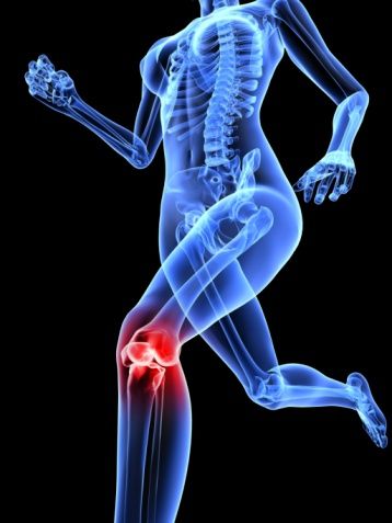 http://www.aurawellnesscenter.com/2014/02/21/how-to-protect-the-knees-in-yoga-classes/ Patellofemoral Pain Syndrome Exercises, Patellofemoral Pain Syndrome, Knee Pain Exercises, Orthopedic Surgeon, Yoga Anatomy, Nerve Pain Relief, Knee Exercises, Knee Replacement, Knee Pain Relief