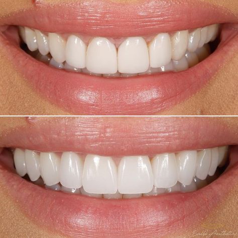 Beautiful Smile Teeth Aesthetic, Small Teeth Smile, Perfect Smile Teeth Women, Veneers Teeth Styles, Beautiful Teeth Smile, Perfect Teeth Aesthetic, Veneers Before And After, Composite Bonding Teeth, Smile Design Dental