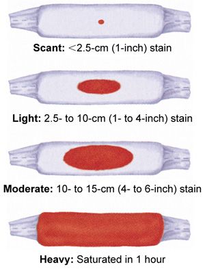 Lochia saturation levels: This is essential to monitor during the initial post-partum period. Remember: Excessive lochia can be a sign of hemorrhage! #Postpartum #OB #Nursing #NewMomma Obstetrics Nursing, Newborn Nursing, Postpartum Nursing, Child Nursing, Student Midwife, Ob Nursing, Mother Baby Nurse, Nursing Mnemonics, Neonatal Nurse