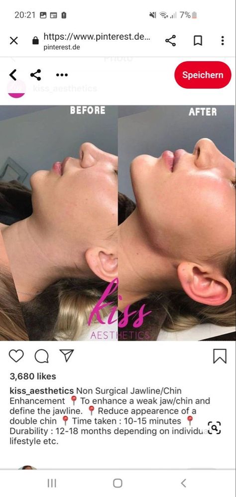 Chin Jaw Filler, Chin Enhancement Before After, Cheek And Chin Filler, Facial Plastic Surgery Before After, Jaw And Chin Filler Before And After, Before And After Jaw Filler, Face Plastic Surgery Before After, Face Surgery Before And After, Jaw Contouring Filler