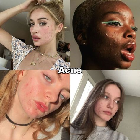 Beautiful insecurities pt.1✨ It's completely normal to have insecurities, but remember that true beauty comes from within. Focus on your positive qualities and embrace your unique features. Remember, you're amazing just the way you are! 😊🌟 Save for later📌 Like, share comment✨ Follow for more!> #acne#freckles#bigforehead#bignose#smalllips#thickeyebrows#teethgap Beautiful Insecurities Acne, Beautiful Insecurities Nose, Embracing Insecurities, Acne Confidence, Acne Is Beautiful, Beautiful Acne, Acne Positivity, Youre Amazing, Acne Beauty