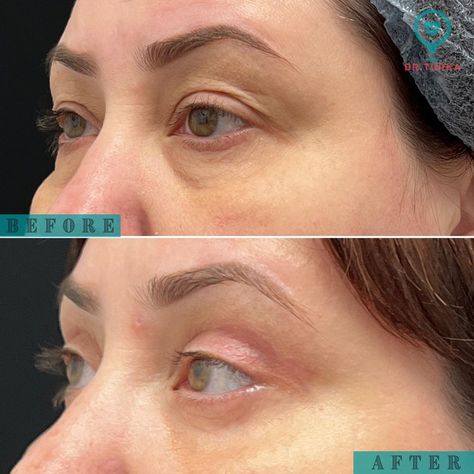 Belfaroplasty Eyes, Upper Blephoraplasty, Upper Eyelid Lift Surgery, Upper Blephoraplasty Before And After, Blephoraplasty Surgery, Blephoraplasty Before And After, Eyelid Surgeries, Hooded Eye Surgery, Eye Lift Surgery