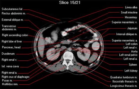 Ct Anatomy, External Oblique, Transversus Abdominis, Vascular Ultrasound, Rectus Abdominis, Computed Tomography, Radiology Imaging, Cat Scan, Vascular Surgery