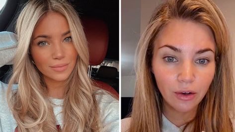 Woman claims people say she 'must be a vampire' after revealing her age Vampire Facial Before And After, Facial Before And After, Facial For Dry Skin, Amber Lancaster, Vampire Facial, Vampire Girls, Effective Skin Care Products, Skin Complexion, Facial Moisturizers