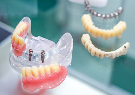 Mini Dental Implants- Article by Harvard Dental School Harvard Dental School, Dental Bridge Before And After, Prosthetic Teeth, Full Arch Dental Implants, Expanded Functions Dental Assistant, Laser Dentistry, American Dental Association, Dental Bridge Cost, Teeth Straightening