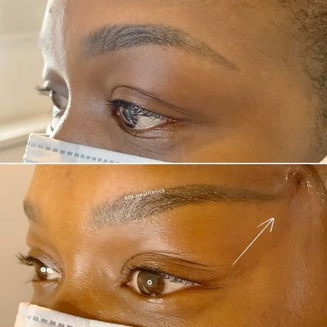 Fox Eye Lift Before And After, Fox Eye Surgery, Fox Eye Lift, Nose Surgery Rhinoplasty, Nose Surgery, Fox Eyes, Eye Surgery, Eye Lift, The Shadow