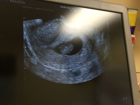 #ultrasound #8weeks Fake Ultrasound Pictures, 3 Weeks Pregnant Ultrasound, 8 Weeks Pregnant Ultrasound, Ultrasound Pictures 8 Weeks, 8 Week Ultrasound, Week 8 Pregnancy, Ultrasound Gender Prediction, 3d Ultrasound Pictures, Fake Ultrasound