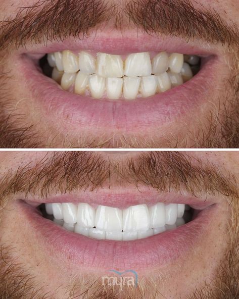 GET-NEW-TEETH-IN-TURKEY
DENTAL CENTRE TURKEY
MYRA DENTAL CENTRE
#teethturkey #veneersturkey #dentalimplantsturkey #teethturkeyprice #dentalcentreturkey #teethturkeyantalya #veneersturkeycost #veneersturkeyantalya #myradentalcentre Dental Center, Smile Makeover, Best Dentist, Get Your Life, Dental Implants, Dental Clinic, Dental Health, Step Guide, Dental Care