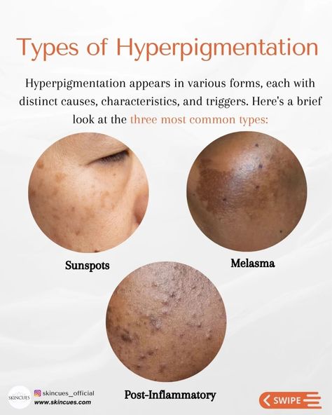 Types of Hyperpigmentation Hyperpigmentation Tips, Remedies For Hyperpigmentation, Hyperpigmentation Remedies, Hyperpigmentation Black Skin, Skin Challenge, Clear Skin Tips, Skin Glowing, Body Hair Removal, Under Eye Bags