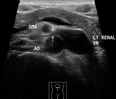 Nutcracker syndrome ultrasound Vascular Sonography, Nutcracker Syndrome, Medical Sonography, Medical Ultrasound, Diagnostic Medical Sonography, Medical Graduate, Interventional Radiology, White Matter, Baby Scan