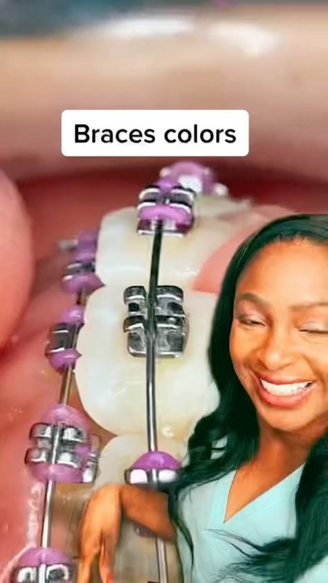 avalene.r on Instagram: 🌟some colors really pop🌟 . #braces #BracesColors #teeth #hygienist #DentalHygienist #RDH Braces Tips, Braces Colors, Dental Hygienist, Braces, Drop Earrings, On Instagram, Instagram, Color