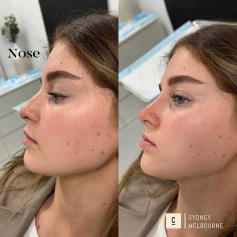 NON-SURGICAL RHINOPLASTY We offer non-surgical consultations for reshaping your nose, to address concerns such as: * A dorsal hump and bumps * Unprojected, undefined noses * Short noses * Hooked nose with a droopy tip * Round or bulbous nose tip * Ski-slope nose * High riding or retracted columella * High riding nostrils * Flaring nostrils * Crooked, bent, and deviated nose * Unsatisfactory surgical rhinoplasty result Want to know if this is an option for you? Comment 'NOSE' to claim your ... Bulbous Nose Rhinoplasty, Nose Rhinoplasty, Neck Lift Surgery, Double Chin Reduction, Nose Fillers, Nose Tip, Bulbous Nose, Hooked Nose, Crooked Nose