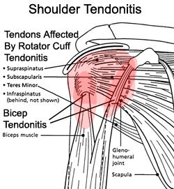 Shoulder Anatomy, Rotator Cuff Exercises, Shoulder Pain Exercises, Shoulder Rehab, Rotator Cuff Injury, Bicep Muscle, Shoulder Pain Relief, Shoulder Surgery, Muscle Anatomy