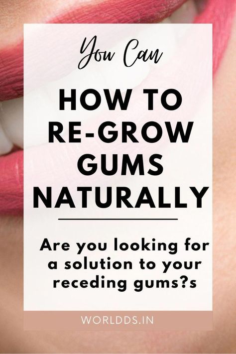 Discover effective strategies for regrowing gums naturally and improving gum health with our comprehensive guide. Learn essential gum care tips, remedies for receding gums at home, and ways to reverse gum problems. Say goodbye to bleeding gums and hello to a brighter, healthier smile! #gumcare #gumhealth #teeth #teethcare #teethremedies #dentalhealth #rebuildgums #recedinggums #teethproblems #cavities #dentist #perfectteeth #WhatIsOralHealthCare Reverse Receding Gums, Grow Back Receding Gums, Fix Teeth, Teeth Remedies, Gum Recession, Teeth Whitening Remedies, Perfect Teeth, Teeth Health, How To Prevent Cavities