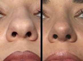 Tip Rhinoplasty, Nose Plastic Surgery, Nose Surgery Rhinoplasty, Bulbous Nose, Rhinoplasty Nose Jobs, Nose Reshaping, Rhinoplasty Before And After, Rhinoplasty Surgery, Lip Art Makeup