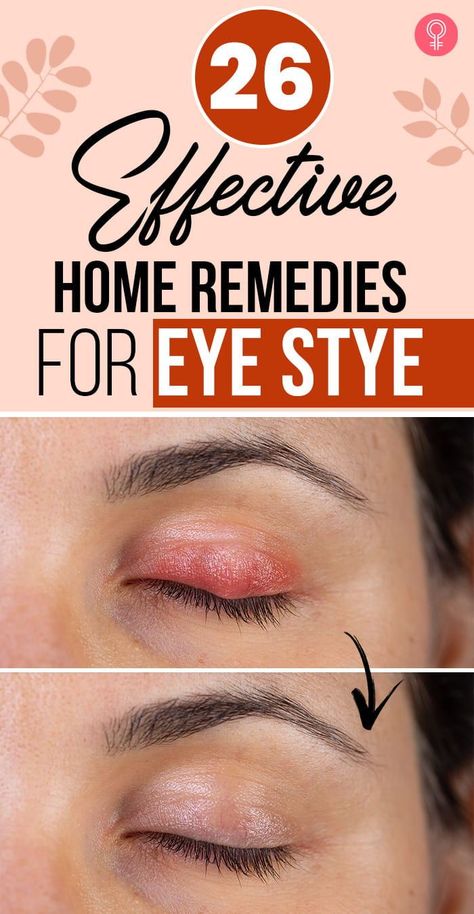 Get Rid Of Stye, Stye Remedy, Eye Stye Remedies, Swollen Eyelid, Swollen Eyes, Itchy Eyes, Sore Eyes, Oral Care Routine, Healthy Diet Tips