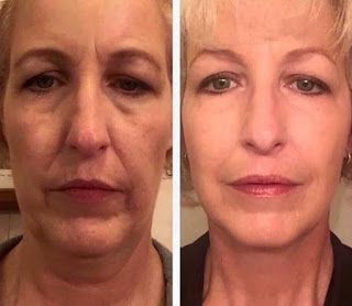 Facial Yoga Exercises, Face Lift Exercises, Double Chin Exercises, Muscles Of The Face, Chin Exercises, Natural Face Lift, Face Yoga Exercises, Facial Toning, Facial Yoga