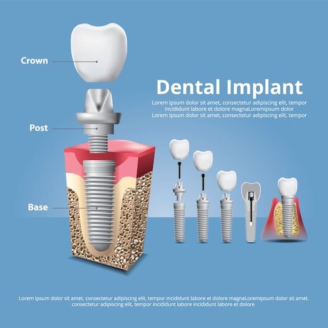 Premium Vector | Human teeth and dental implant Medicine Poster, Dental Posters, Thank You Nurses, Medical Posters, Human Teeth, Dental Marketing, Teeth Implants, Dental Implant, Dental Implants