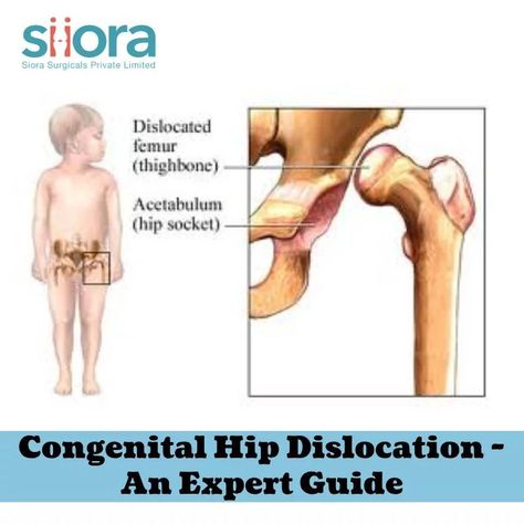 Well, Hip Dislocation can also occur in newborns and the condition is congenital hip dislocation, and this is what we will discuss in the post. Let us start with a brief introduction to the condition. Dislocated Hip, Hip Dislocation, Talk About, Conditioner, Let It Be