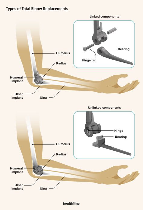 Elbow Surgery, Preparing For Surgery, Arm Bones, Ulnar Nerve, Rehabilitation Exercises, Elbow Pain, Knee Replacement, Scar Tissue, After Surgery