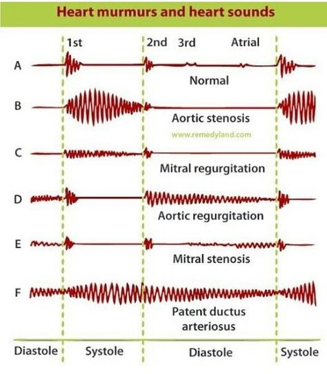 Patent Ductus Arteriosus, Nursing School Studying Cheat Sheets, Heart Diagram, Heart Sounds, Pa School, Platelet Rich Plasma, Best Nursing Schools, Instagram Heart, Lpn Nursing