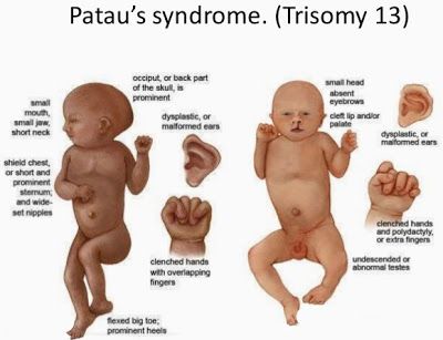 Patau Syndrome, Edwards Syndrome, Ultrasound School, Medical Images, Chromosomal Abnormalities, Auditory Processing Disorder, Rare Genetic Disorders, Children Quotes, My Children Quotes