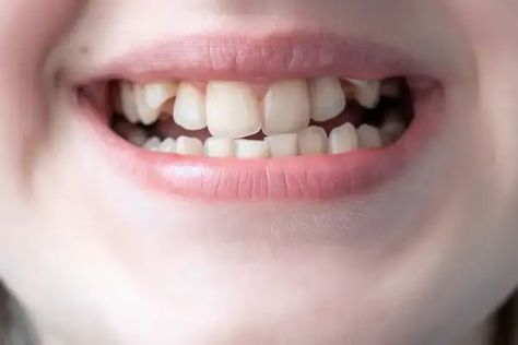 Do you hate the way your teeth look? Your teeth are an integral part of your smile and… The post Why Are My Teeth Crooked? What Causes Crooked Teeth? appeared first on Florida Independent 🌈. Deep Teeth Cleaning, Loose Teeth, Smile Tips, Teeth Aesthetic, Crooked Smile, Crooked Teeth, Loose Tooth, Perfect Teeth, Smile Teeth