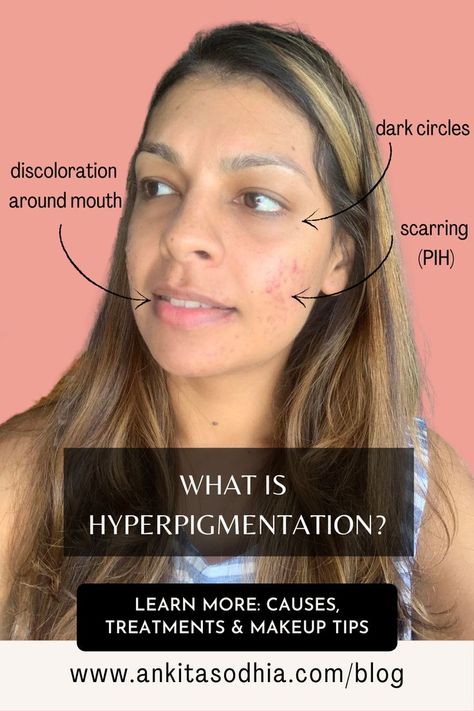 Here's a blog post all about what causes hyperpigmentation; what helps hyperpigmentation; the three types of hyperpigmentation; and makeup tips to cover hyperpigmentation. Treat Hyperpigmentation, Treating Hyperpigmentation, Receding Gums, Fitness Beauty, Dark Circles, Different Types, Healthy Life, Makeup Tips, Need To Know