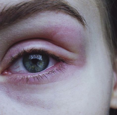 red swollen painful eye after allergic reaktion, green eyecolor, pale skin Eye Bruising, Swollen Eye, Travis Phelps, Brain Juice, Novel Aesthetic, Swollen Eyes, Eyeball Art, Irritated Eye, Pale Face