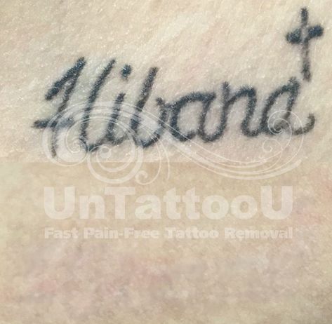 Before & After  [Complete removal on this all black professional tattoo located on clients clavicle. Tattoo is approximately 1 square inch in size.]  #UnTattooU #lasertattooremoval #tattooremoval #tattooregret #PicoSure #CynoSure #tattooremovalspecialists #painfree #lasertreatment #skin #inked #professionaltattoos #tattoos #aesthetics #cleanslate Clavicle Tattoo, No Regrets Tattoo, Laser Tattoo, Laser Tattoo Removal, Free Tattoo, Professional Tattoo, Tattoo Removal, Pain Free, Latest Technology